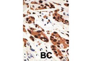 Formalin-fixed and paraffin-embedded human cancer tissue reacted with GJB5 polyclonal antibody  , which was peroxidase-conjugated to the secondary antibody, followed by AEC staining. (GJB5 antibody  (Internal Region))