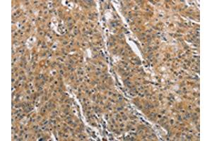 The image on the left is immunohistochemistry of paraffin-embedded Human gastric cancer tissue using ABIN7129185(DDX53 Antibody) at dilution 1/75, on the right is treated with fusion protein.