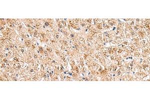 Immunohistochemistry of paraffin-embedded Human liver cancer tissue using HCCS Polyclonal Antibody at dilution of 1:110(x200) (HCCS antibody)