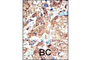 Formalin-fixed and paraffin-embedded human cancer tissue reacted with the primary antibody, which was peroxidase-conjugated to the secondary antibody, followed by DAB staining. (EPH Receptor B1 antibody  (C-Term))