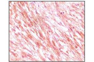 Immunohistochemical analysis of paraffin-embedded maligant mesenchymoma tissues, showing cytoplasmic localization using C-kit mouse mAb with DAB staining. (KIT antibody)