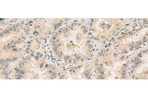 Immunohistochemistry of paraffin-embedded Human lung cancer tissue using HHIPL2 Polyclonal Antibody at dilution of 1:55(x200) (HHIPL2 antibody)