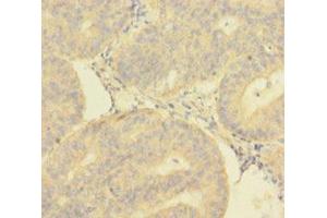 Immunohistochemistry of paraffin-embedded human endometrial cancer using ABIN7149718 at dilution of 1:100 (DNTTIP1 antibody  (AA 1-329))