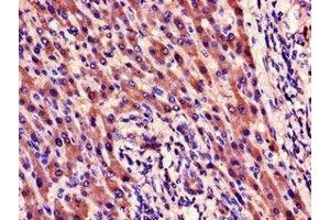 Immunohistochemistry of paraffin-embedded human liver cancer using ABIN7165238 at dilution of 1:100