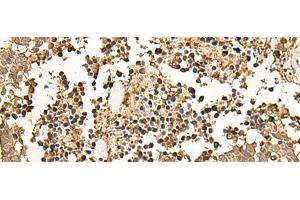 Immunohistochemistry of paraffin-embedded Human lung cancer tissue using LDHA Polyclonal Antibody at dilution of 1:25(x200) (Lactate Dehydrogenase A antibody)