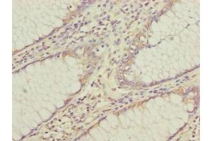 Immunohistochemistry of paraffin-embedded human colon cancer using ABIN7147439 at dilution of 1:100 (CEP95 antibody  (AA 582-821))
