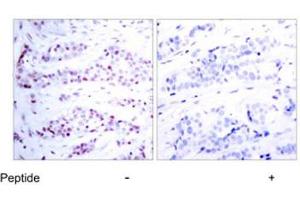 Imunohistochemical analysis of paraffin-embedded human breast carcinoma tissue using STAT6 polyclonal antibody . (STAT6 antibody)