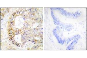 Immunohistochemistry analysis of paraffin-embedded human colon carcinoma tissue, using COX41 Antibody.