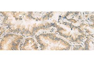 Immunohistochemistry of paraffin-embedded Human lung cancer tissue using RAB13 Polyclonal Antibody at dilution of 1:50(x200)