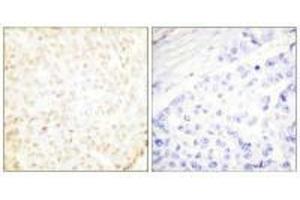Immunohistochemistry analysis of paraffin-embedded human breast carcinoma tissue using XRCC5 antibody. (XRCC5 antibody  (C-Term))