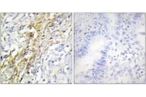 Immunohistochemistry analysis of paraffin-embedded human lung carcinoma tissue, using CKI-alpha Antibody.