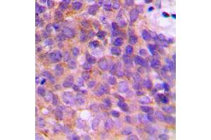 Immunohistochemical analysis of KCNAB3 staining in human breast cancer formalin fixed paraffin embedded tissue section. (KCNAB3 antibody  (C-Term))