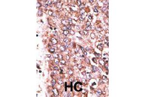 Formalin-fixed and paraffin-embedded human hepatocellular carcinoma tissue reacted with WISP3 polyclonal antibody  , which was peroxidase-conjugated to the secondary antibody, followed by DAB staining. (WISP3 antibody  (Internal Region))