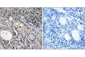 Immunohistochemistry analysis of paraffin-embedded human prostate carcinoma tissue, using RPL17 Antibody. (RPL17 antibody  (AA 101-150))