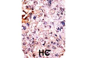 Formalin-fixed and paraffin-embedded human cancer tissue reacted with the primary antibody, which was peroxidase-conjugated to the secondary antibody, followed by AEC staining. (CDKN1B antibody  (pThr187))