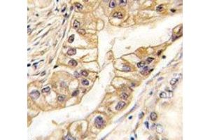 IHC analysis of FFPE human lung carcinoma tissue stained with EPHB2 antibody (EPH Receptor B2 antibody)