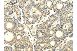 The image on the left is immunohistochemistry of paraffin-embedded Human thyroid cancer tissue using ABIN7193043(WDR91 Antibody) at dilution 1/20, on the right is treated with synthetic peptide. (WDR91 antibody)