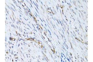Immunohistochemistry of paraffin-embedded human uterine cancer using SELE Antibody (ABIN5971217) at dilution of 1/100 (40x lens). (Selectin E/CD62e antibody)