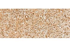 Immunohistochemistry of paraffin-embedded Human liver cancer tissue using HIRIP3 Polyclonal Antibody at dilution of 1:60(x200) (HIRIP3 antibody)