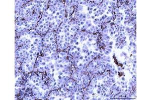 IHC analysis of Vimentin using anti-Vimentin antibody (ABIN3042344).