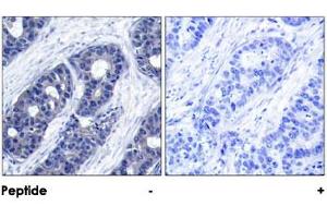 Immunohistochemical analysis of paraffin-embedded human breast carcinoma tissue using IRS1 polyclonal antibody . (IRS1 antibody)