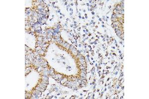 使用RHOG抗体（ABIN7269864）在1:100（40倍晶状体）稀释度下对石蜡包埋的人类结肠癌进行免疫组化。（RHOG抗体）