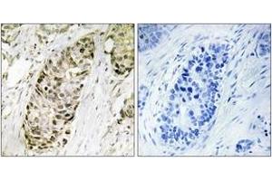 Immunohistochemistry analysis of paraffin-embedded human lung carcinoma tissue, using GA45G Antibody. (GADD45G antibody  (AA 101-150))