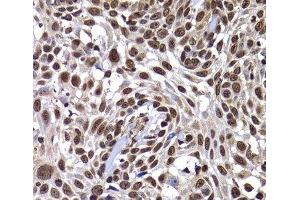 Immunohistochemistry of paraffin-embedded Human well-differentiated squamous skin carcinoma using DNAJB6 Polyclonal Antibody at dilution of 1:100 (40x lens). (DNAJB6 antibody)