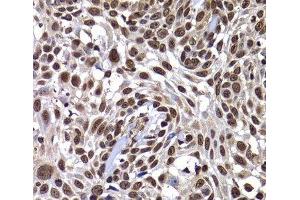 Immunohistochemistry of paraffin-embedded Human well-differentiated squamous skin carcinoma using DNAJB6 Polyclonal Antibody at dilution of 1:100 (40x lens).