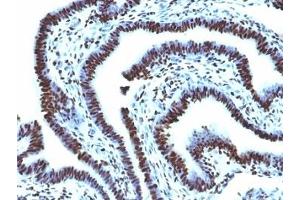 Formalin-fixed, paraffin-embedded human ovarian carcinoma stained with Histone H1 antibody (AE-4) (Histone antibody)