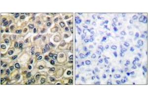 Immunohistochemistry analysis of paraffin-embedded human breast carcinoma tissue, using Claudin 1 Antibody. (Claudin 1 antibody  (AA 162-211))