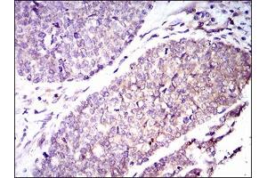 Immunohistochemical analysis of paraffin-embedded esophageal cancer tissues using GUCY1A3 mouse mAb with DAB staining.