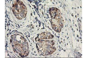 Immunohistochemical staining of paraffin-embedded Adenocarcinoma of Human breast tissue using anti-DAND5 mouse monoclonal antibody.