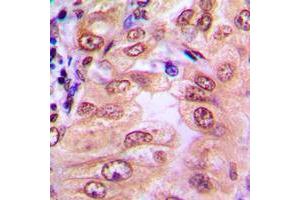 Immunohistochemical analysis of SMAD1/9 (pS465/467) staining in human breast cancer formalin fixed paraffin embedded tissue section. (Smad1/9 antibody  (C-Term, pSer465, pSer467))