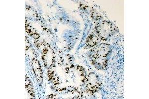 Immunohistochemical analysis of HNF4 alpha staining in human colon cancer formalin fixed paraffin embedded tissue section. (HNF4A antibody)