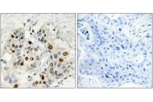 Immunohistochemistry analysis of paraffin-embedded human breast carcinoma tissue, using AF4 Antibody. (AF4 antibody  (AA 1-50))