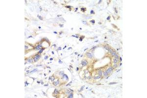 Immunohistochemistry of paraffin-embedded human liver cancer using TXN2 antibody (ABIN6291019) at dilution of 1:100 (40x lens). (TXN2 antibody)