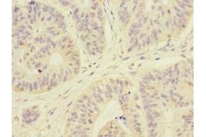 Immunohistochemistry of paraffin-embedded human colon cancer using ABIN7167980 at dilution of 1:100 (ARHGEF3 antibody  (AA 287-526))