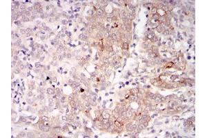 Immunohistochemical analysis of paraffin-embedded human cervical cancer tissues using BLNK mouse mAb with DAB staining. (B-Cell Linker antibody)