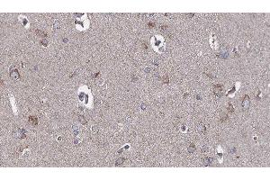 ABIN6276680 at 1/100 staining Human brain cancer tissue by IHC-P. (TLR3 antibody  (C-Term))