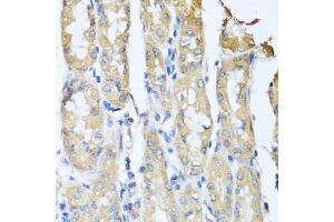 Immunohistochemistry of paraffin-embedded human gastric cancer using CCL3 antibody (ABIN5974742) at dilution of 1/100 (40x lens). (CCL3 antibody)