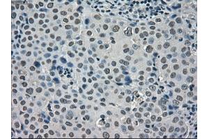 Immunohistochemical staining of paraffin-embedded Adenocarcinoma of ovary tissue using anti-SATB1mouse monoclonal antibody. (SATB1 antibody)