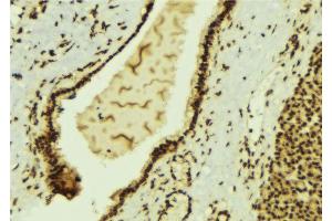 ABIN6269400 at 1/100 staining Human breast cancer tissue by IHC-P. (HDAC6 antibody  (N-Term))