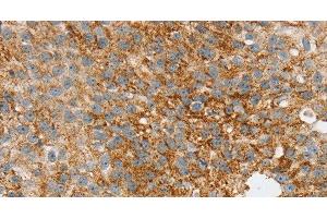 Immunohistochemistry of paraffin-embedded Human breast cancer tissue using SPARCL1 Polyclonal Antibody at dilution 1:30 (SPARCL1 antibody)