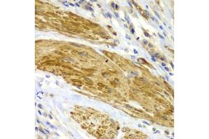 Immunohistochemistry of paraffin-embedded human gastric cancer using CDK6 antibody. (CDK6 antibody)