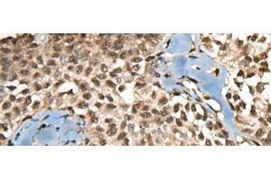 Immunohistochemistry of paraffin-embedded Human ovarian cancer tissue using CCDC12 Polyclonal Antibody at dilution of 1:60(x200) (CCDC12 antibody)