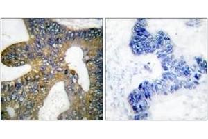 Immunohistochemistry analysis of paraffin-embedded human colon carcinoma tissue, using HSP105 Antibody.