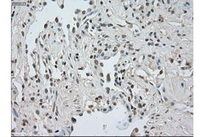 Immunohistochemical staining of paraffin-embedded Adenocarcinoma of breast tissue using anti-CTAG1B mouse monoclonal antibody. (CTAG1B antibody)