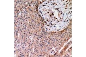 Immunohistochemical analysis of RAB24 staining in human breast cancer formalin fixed paraffin embedded tissue section.