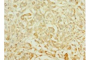 Immunohistochemistry of paraffin-embedded human pancreatic cancer using ABIN7164617 at dilution of 1:100 (TTLL2 antibody  (AA 401-592))